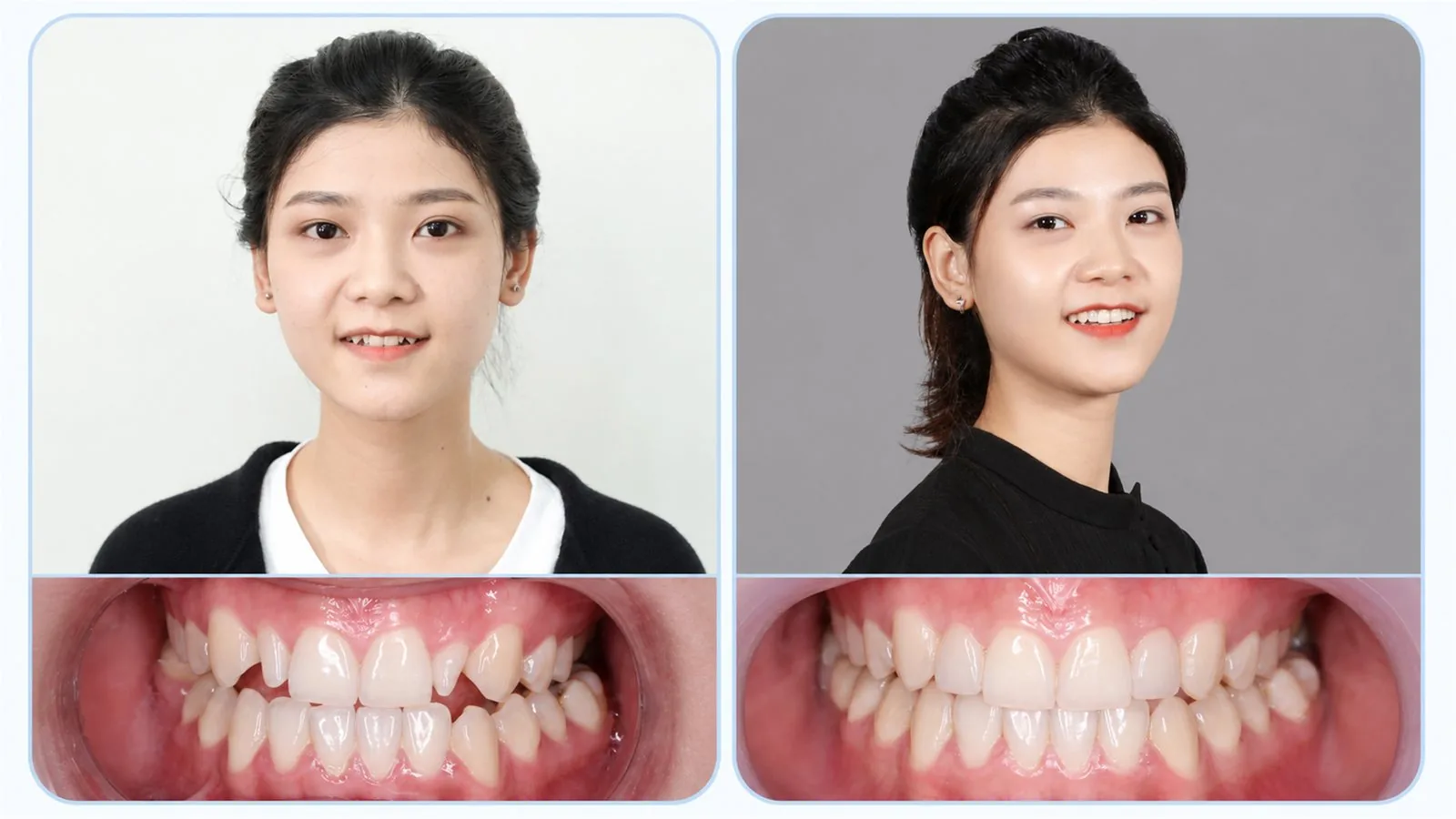 Ca răng sứ thực tế 1 — hình ảnh trước và sau khi làm răng sứ tại Nha khoa Hân Đào