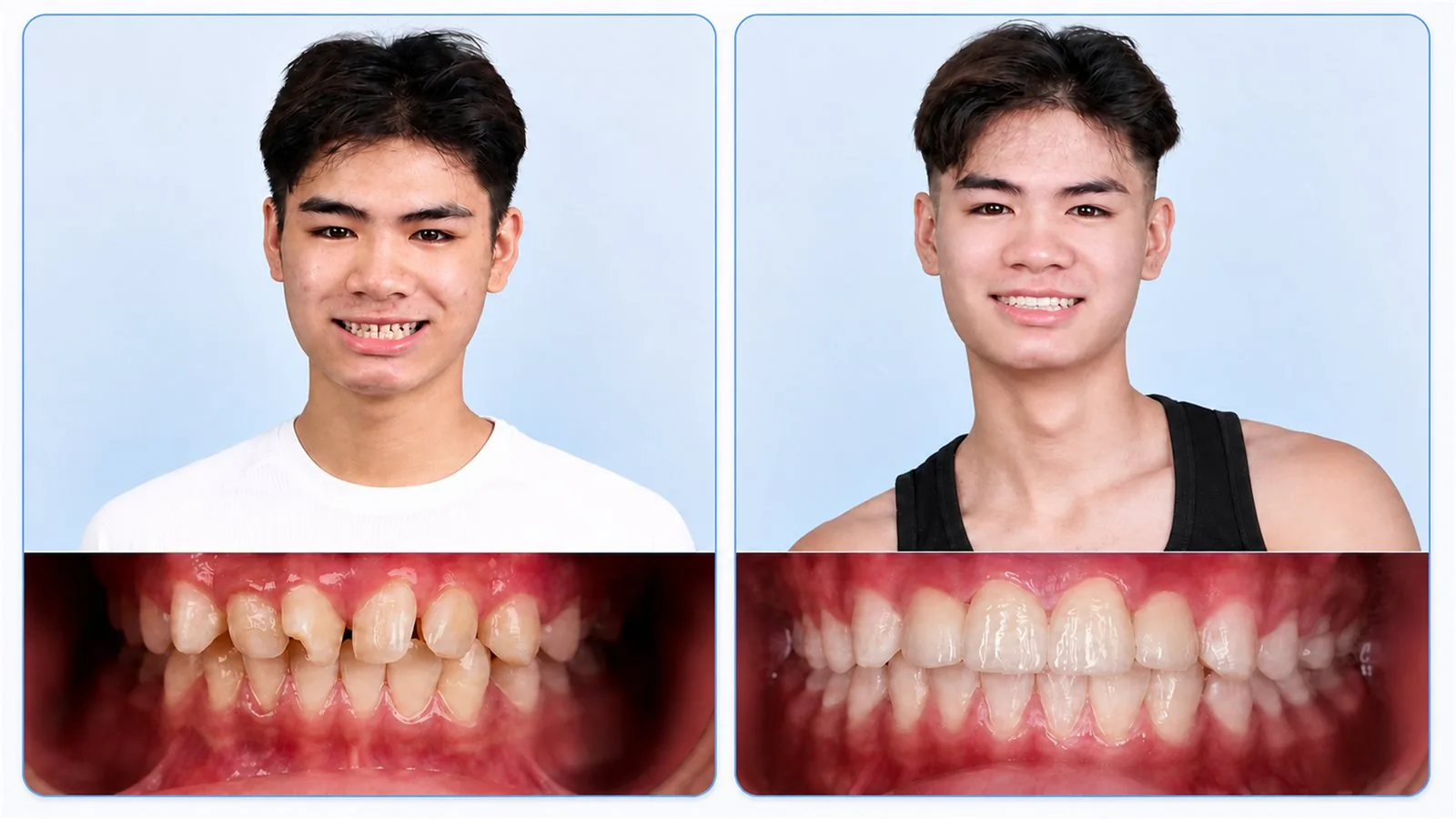 Ca răng sứ thực tế 2 — hình ảnh trước và sau khi làm răng sứ tại Nha khoa Hân Đào