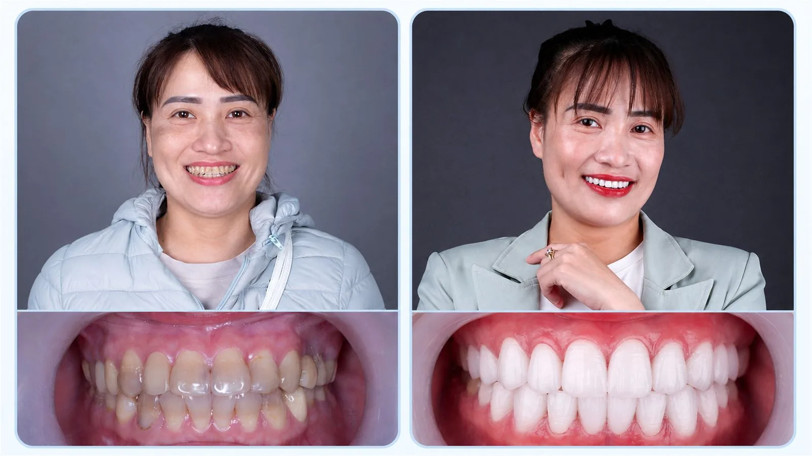 Ca răng sứ thực tế 3 — hình ảnh trước và sau khi làm răng sứ tại Nha khoa Hân Đào