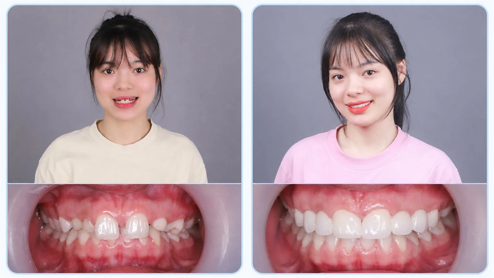 Ca răng sứ thực tế 4 — hình ảnh trước và sau khi làm răng sứ tại Nha khoa Hân Đào